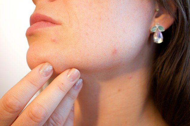 ¿Qué es el acné y cómo eliminarlo?